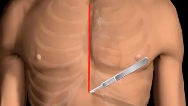 一文讀懂冠狀動(dòng)脈搭橋術(shù)（系列二)