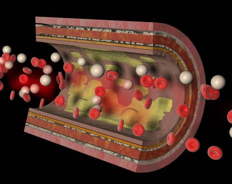 誘發(fā)動(dòng)脈硬化的因素有哪